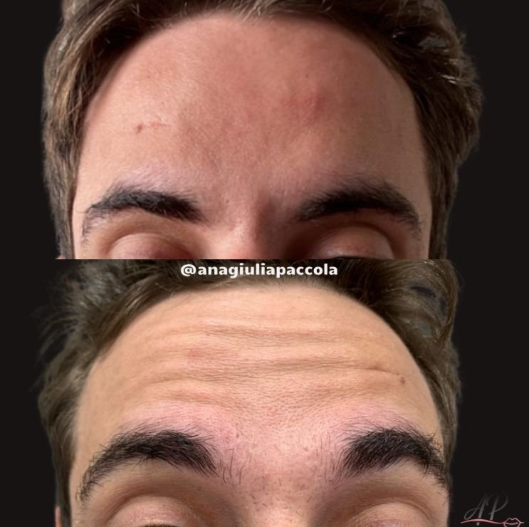 Antes e depois Botox 1