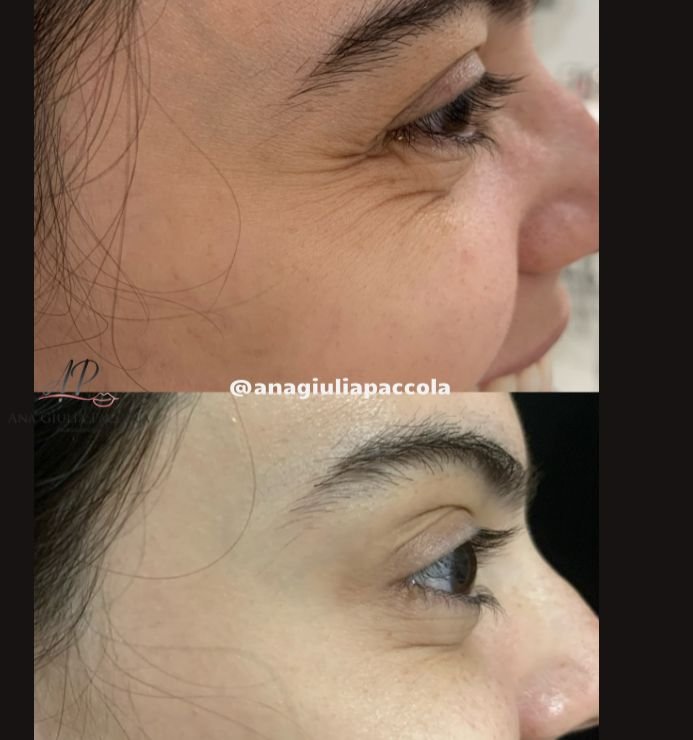 Antes e depois Botox 6