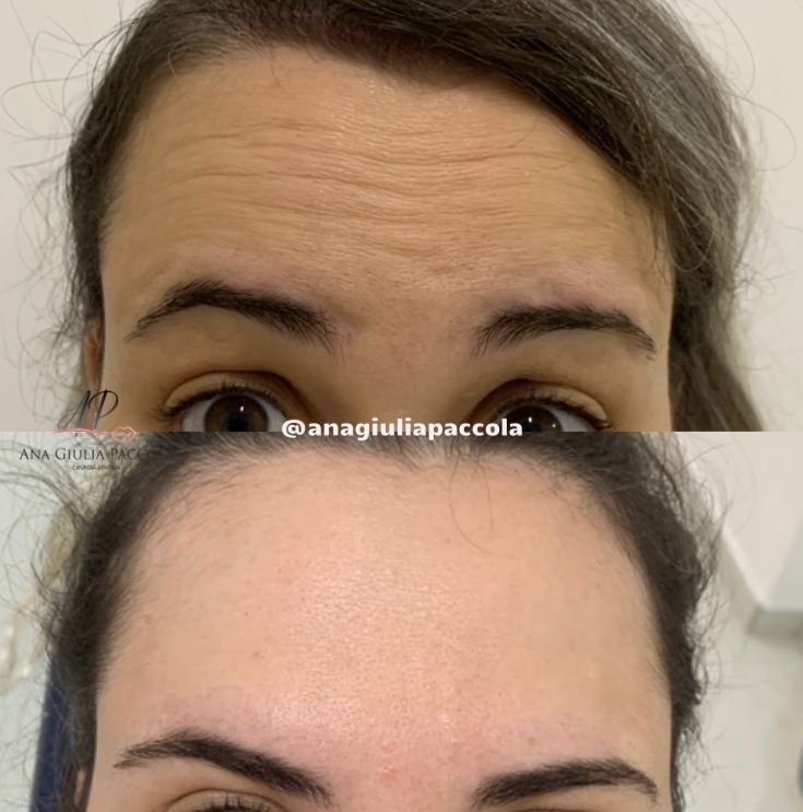 Antes e depois Botox 7