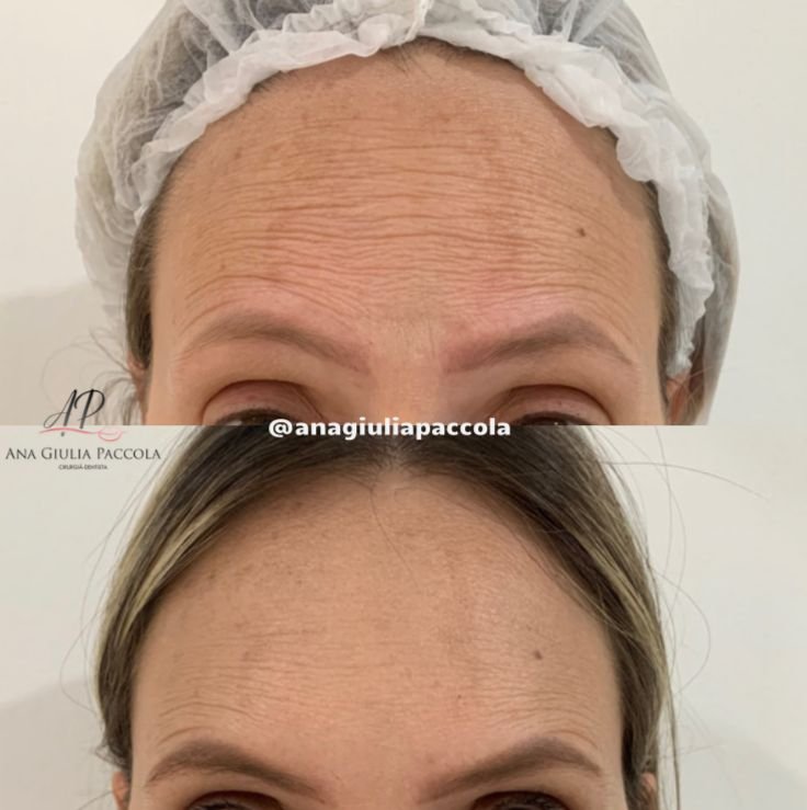 Antes e depois Botox 8