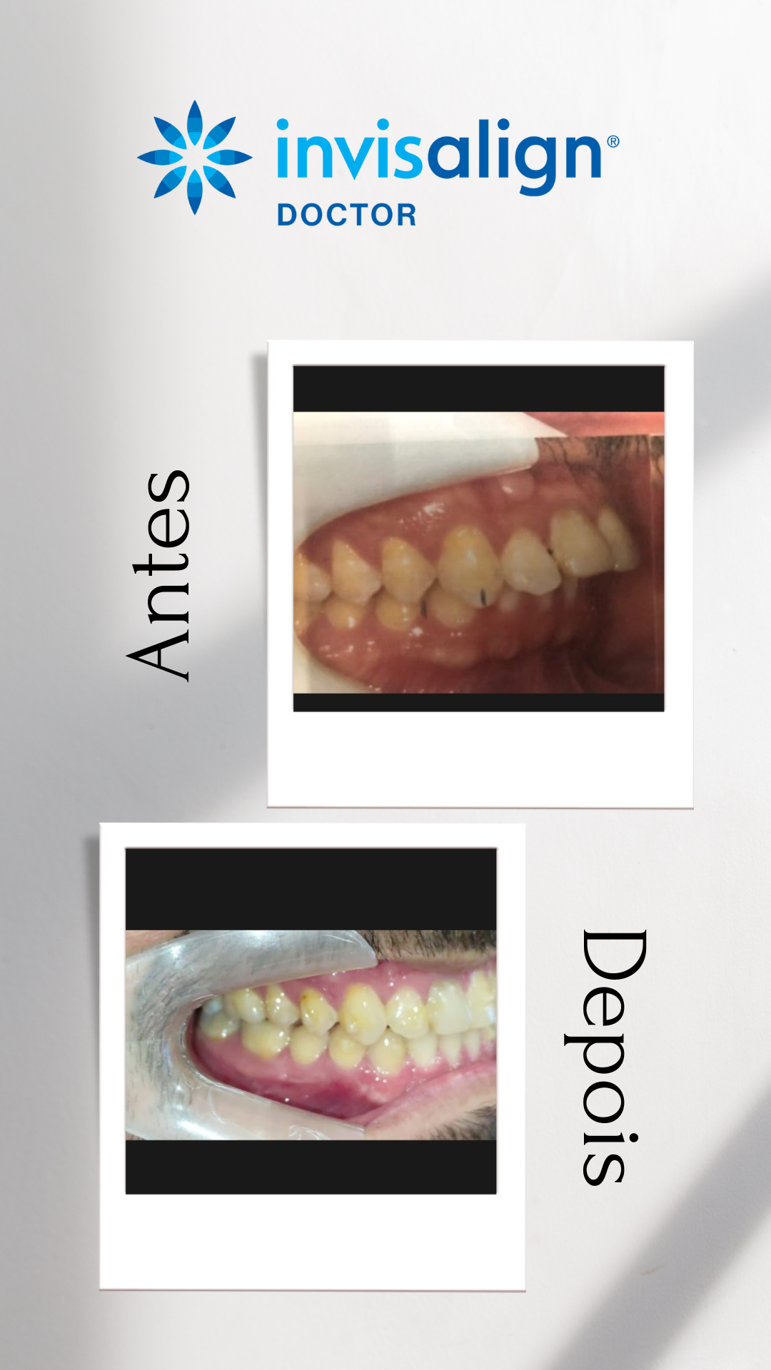 Antes e depois Invisalign 3