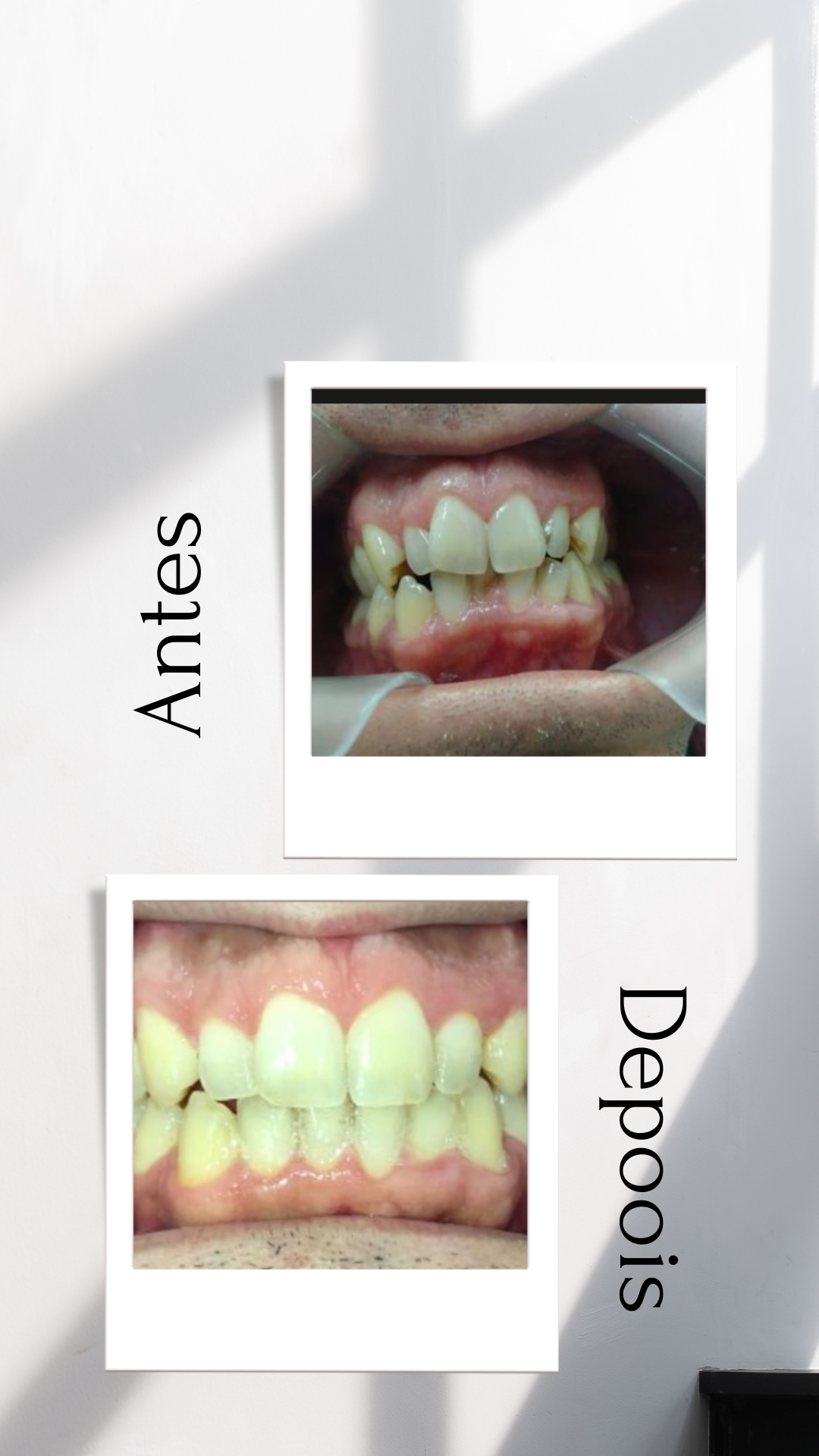 Antes e depois Invisalign 4
