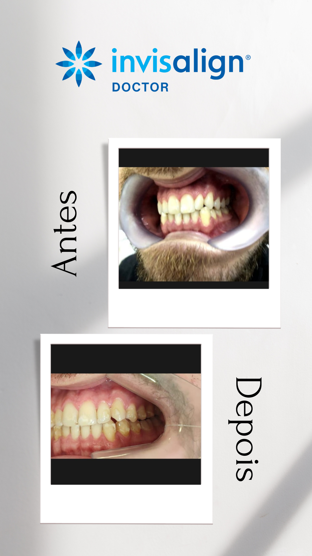 Antes e depois Invisalign 5