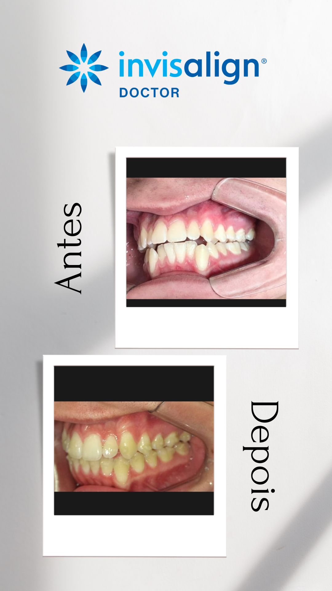 Antes e depois Invisalign 7