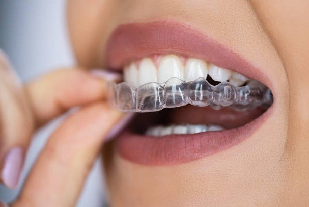 Visualização digital do tratamento Invisalign
