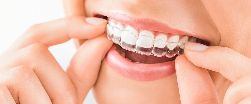 Paciente utilizando alinhador transparente Invisalign