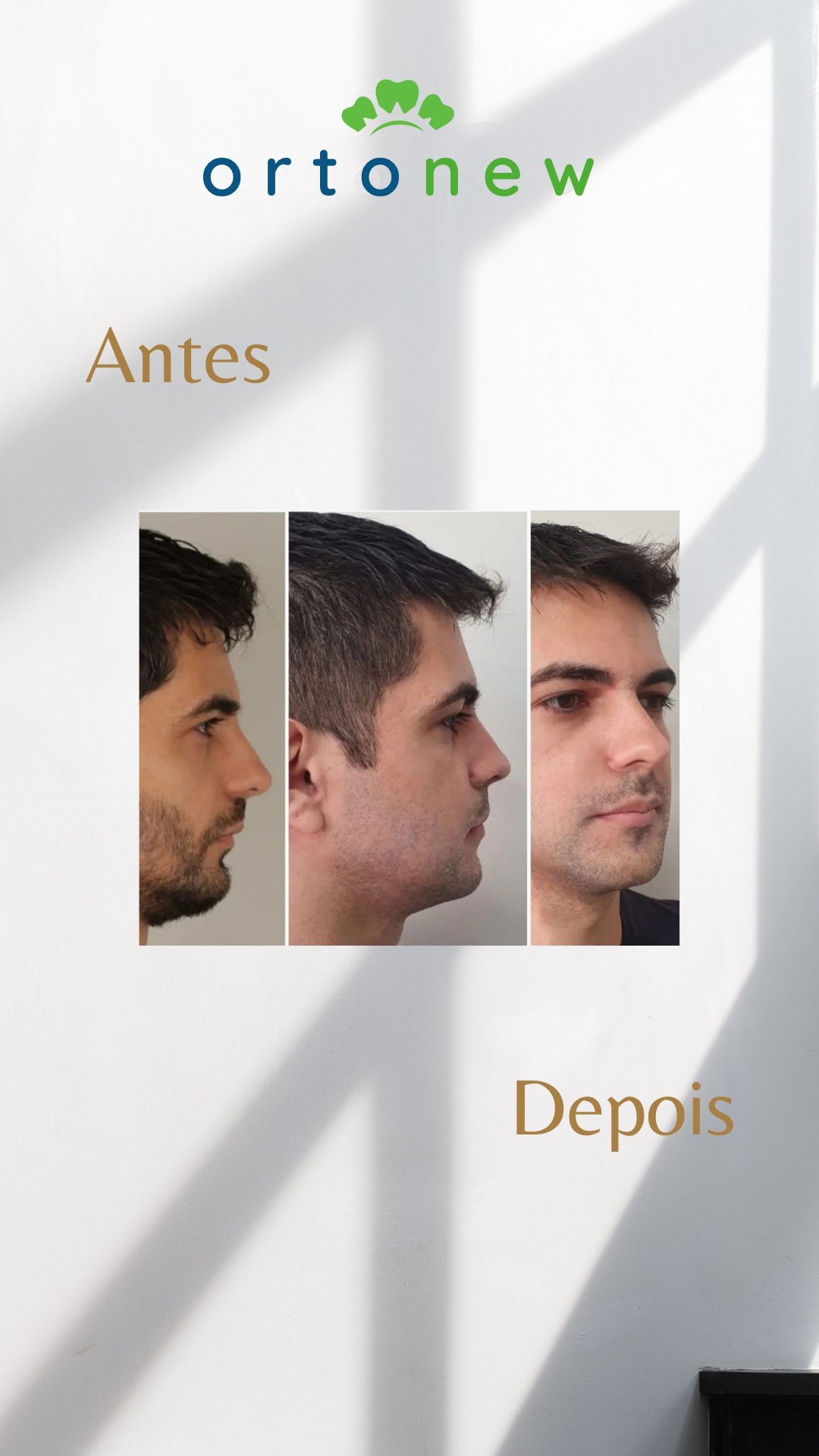 Antes e depois Botox 3