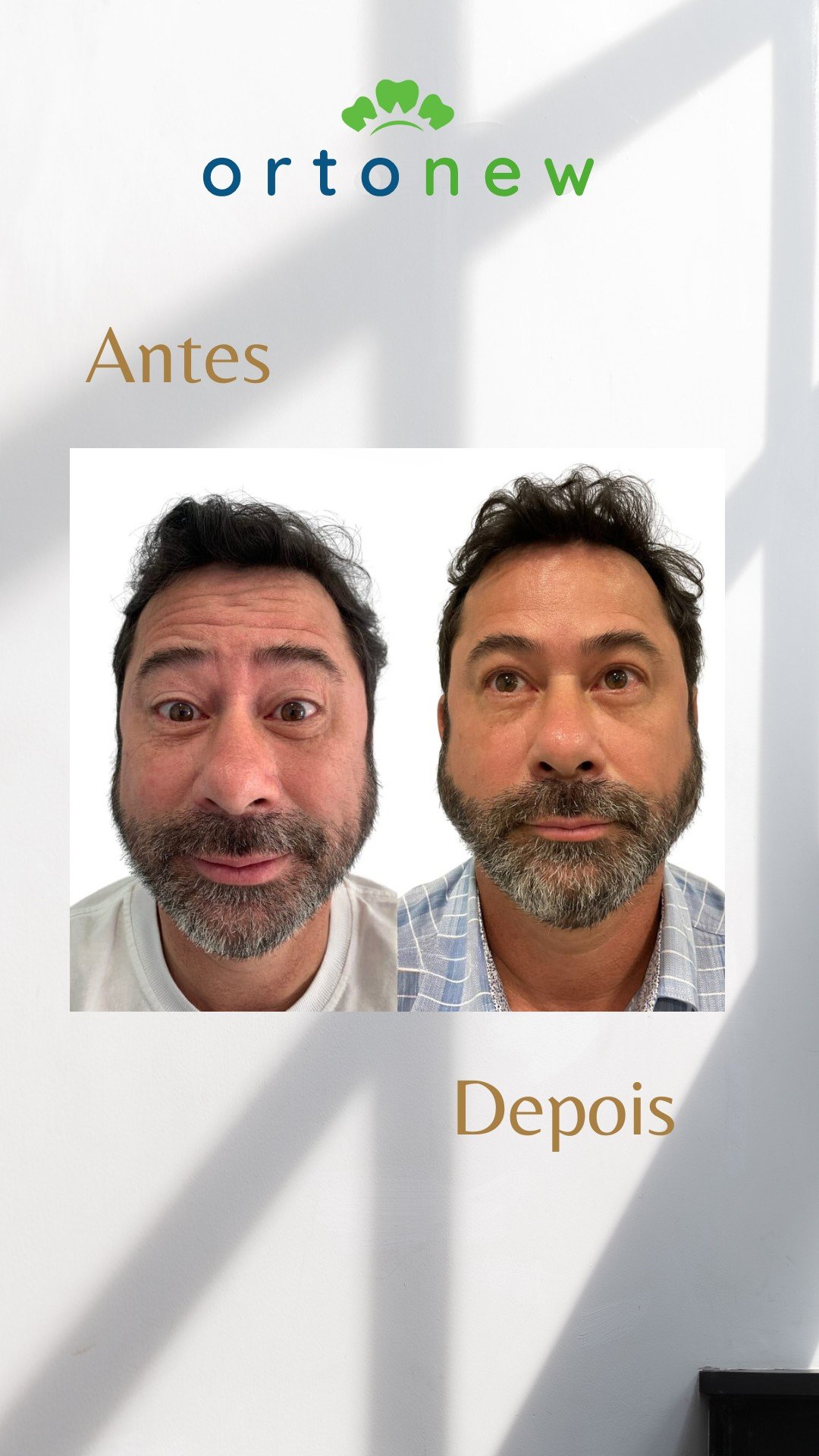 Antes e depois Botox 4