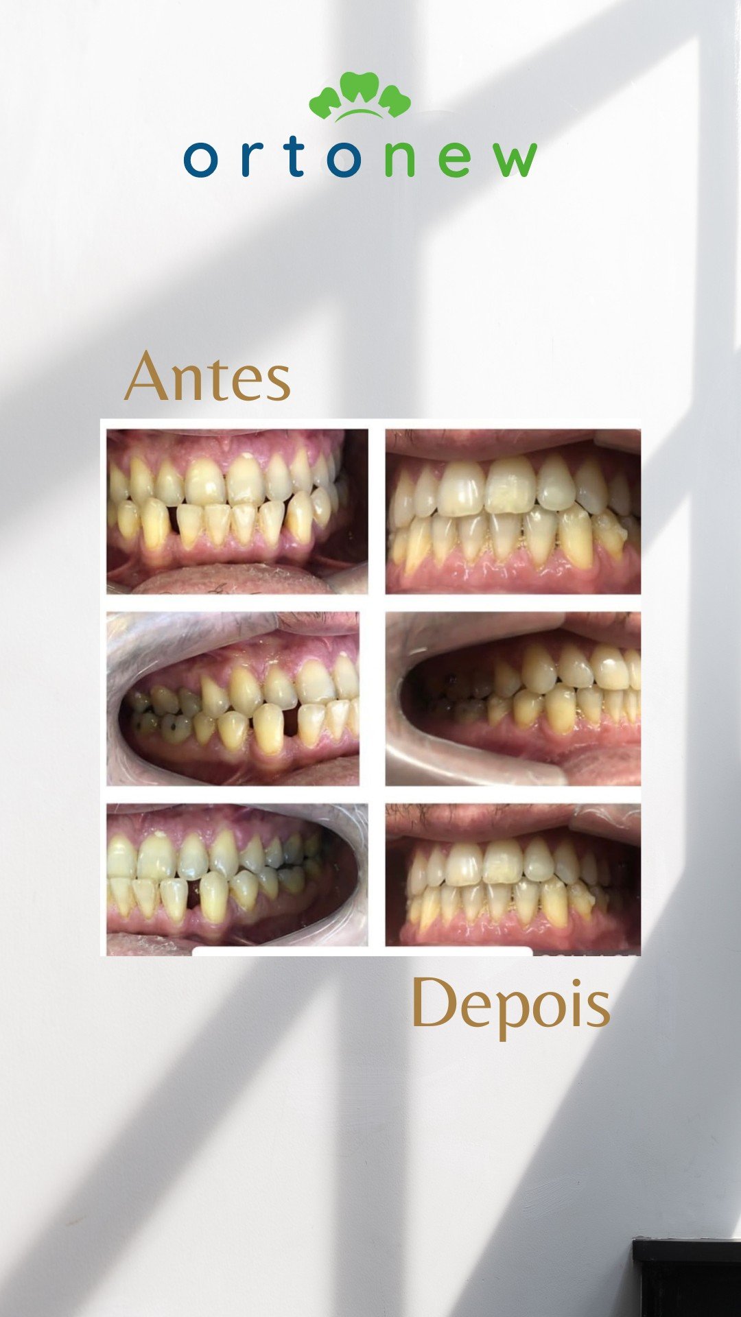 Antes e depois Invisalign 1
